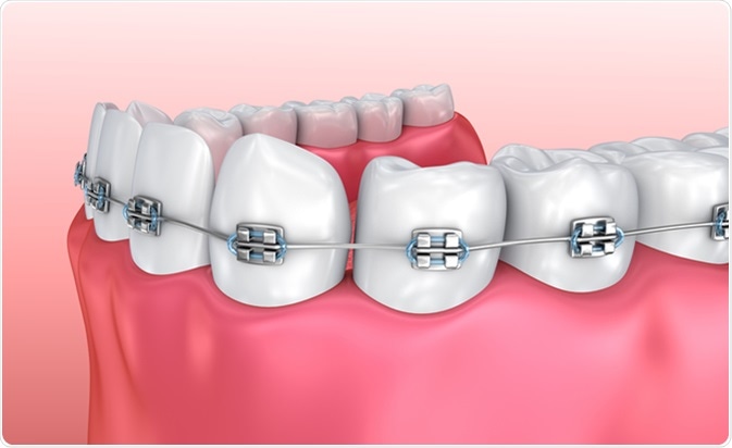 braces..